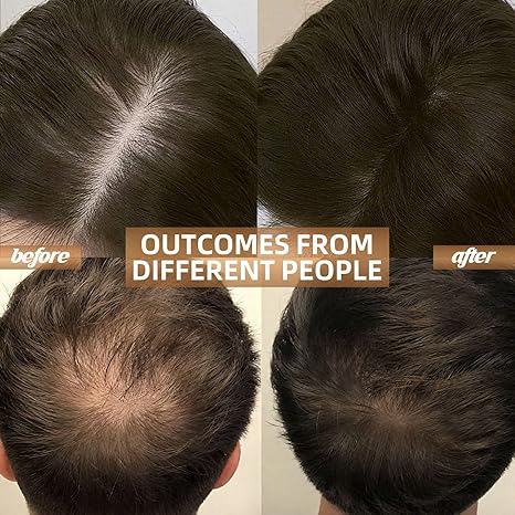 DENSIA™ Laser Hair Growth Cap for Hair Loss