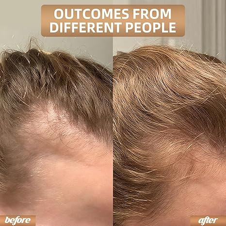 DENSIA™ Laser Hair Growth Cap for Hair Loss